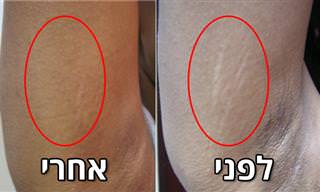 8 תכשירים ביתיים להעלמת סימני מתיחה