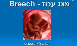 על לידה במצג עכוז